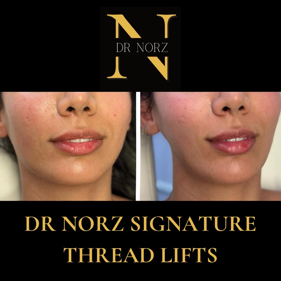 DR - DR NORZ Signature Thread-lifts Before and After. • Instant Results ...