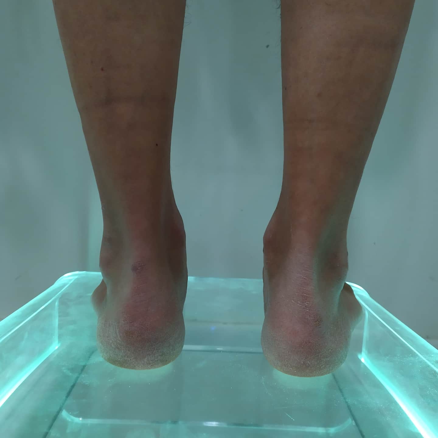 Podoruiz - Heel rise test + (disfunción del t. Tibial... | Facebook