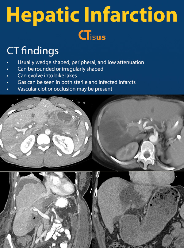 CTisus: - Hepatic Infarction: CT Findings https://ctisus.com/learning ...