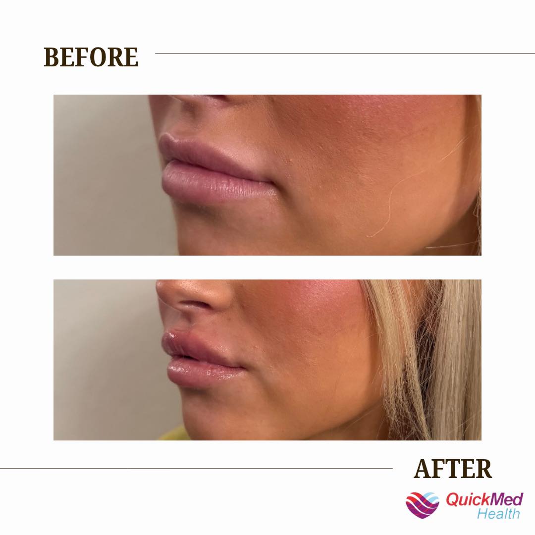 New at QuickMed Health! 🎉 Ever heard of KLOW + GLOW peptides and wondered what the hype is about? Let us break it down for you! 💧 KLOW Supports healthy skin, hair