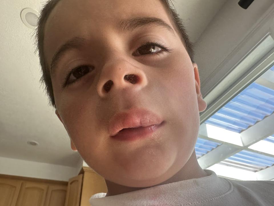 What happened to my non-verbal son's bruise at school?