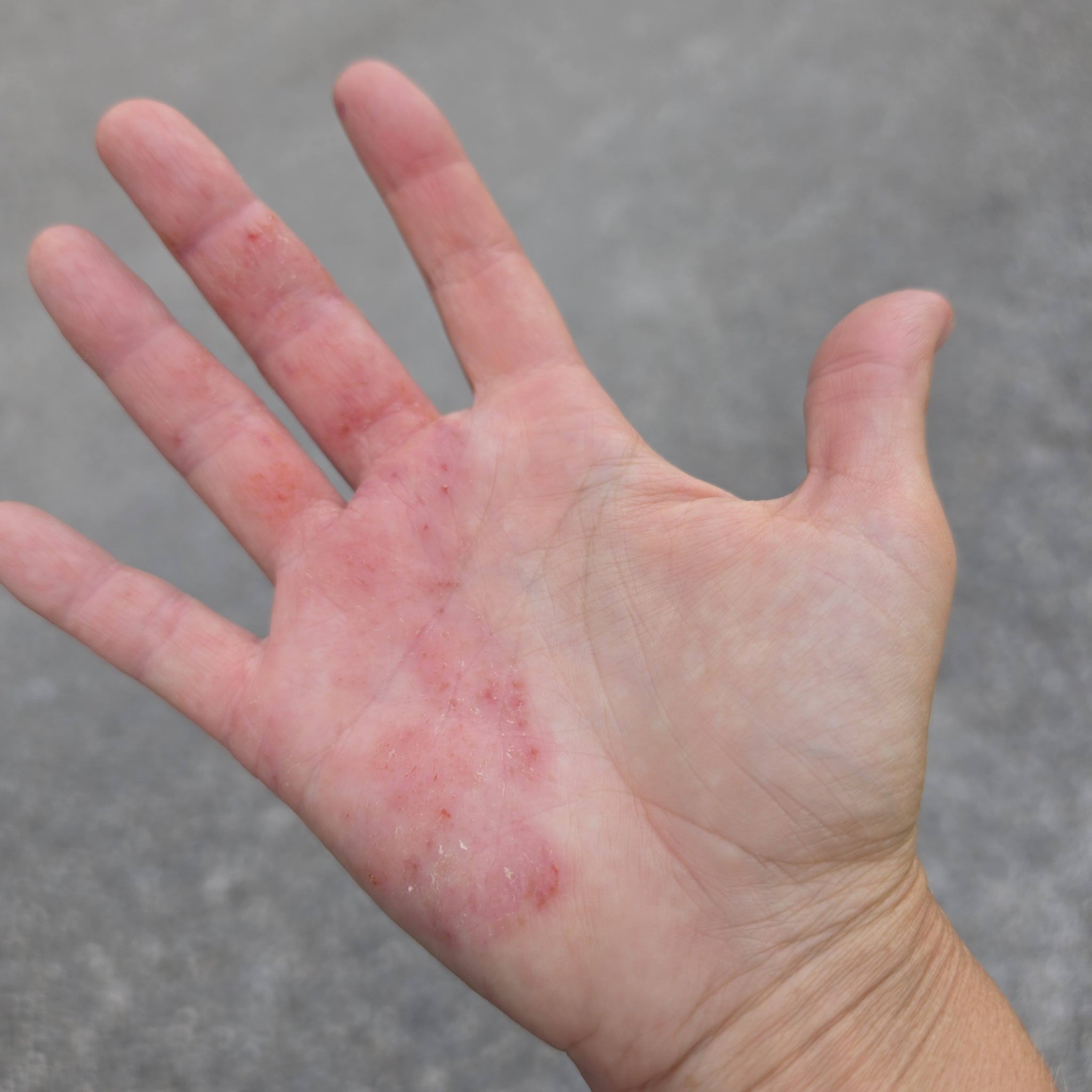 Anyone else here on tirzepatide? Ever since I have been taking it and losing weight along with going to the gym 5 days a week, my hands have been completely clear despite
