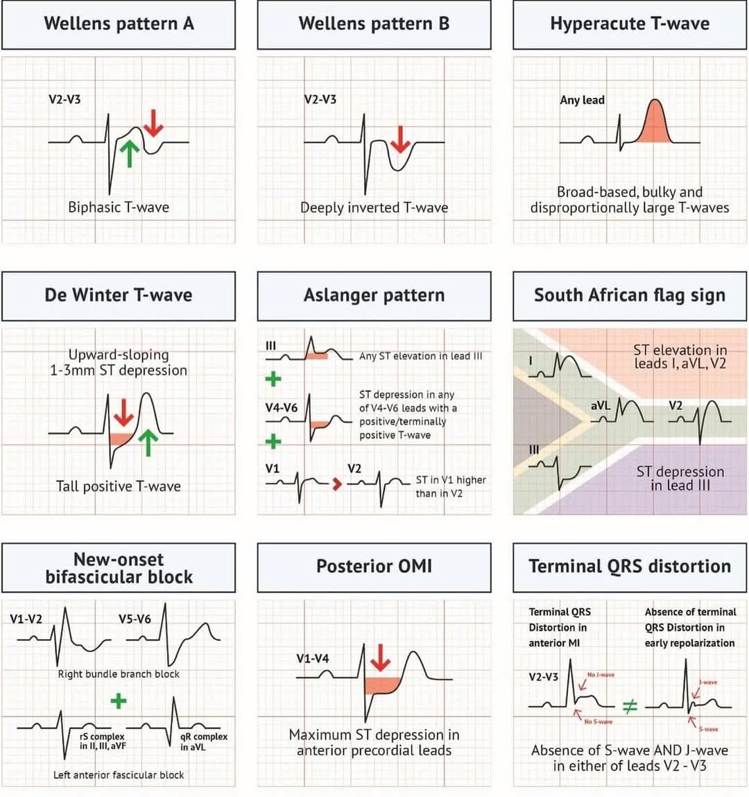 ECG Patterns🫀 . . . . #ecg #ekg... - Cardiology online | Facebook