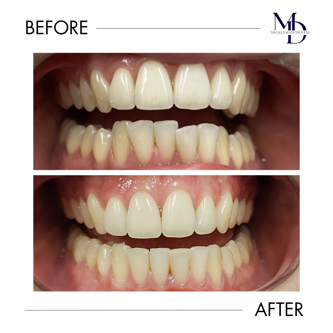 Mickleham - BEFORE & AFTER with Sure Smile Clear Aligners Our patient ...