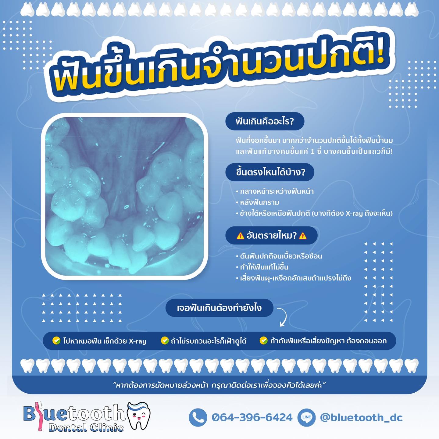 Bluetooth - 🦷 Supernumerary Teeth – ฟันเกินที่คุณอาจไม่รู้ว่ามีอยู่ใน ...