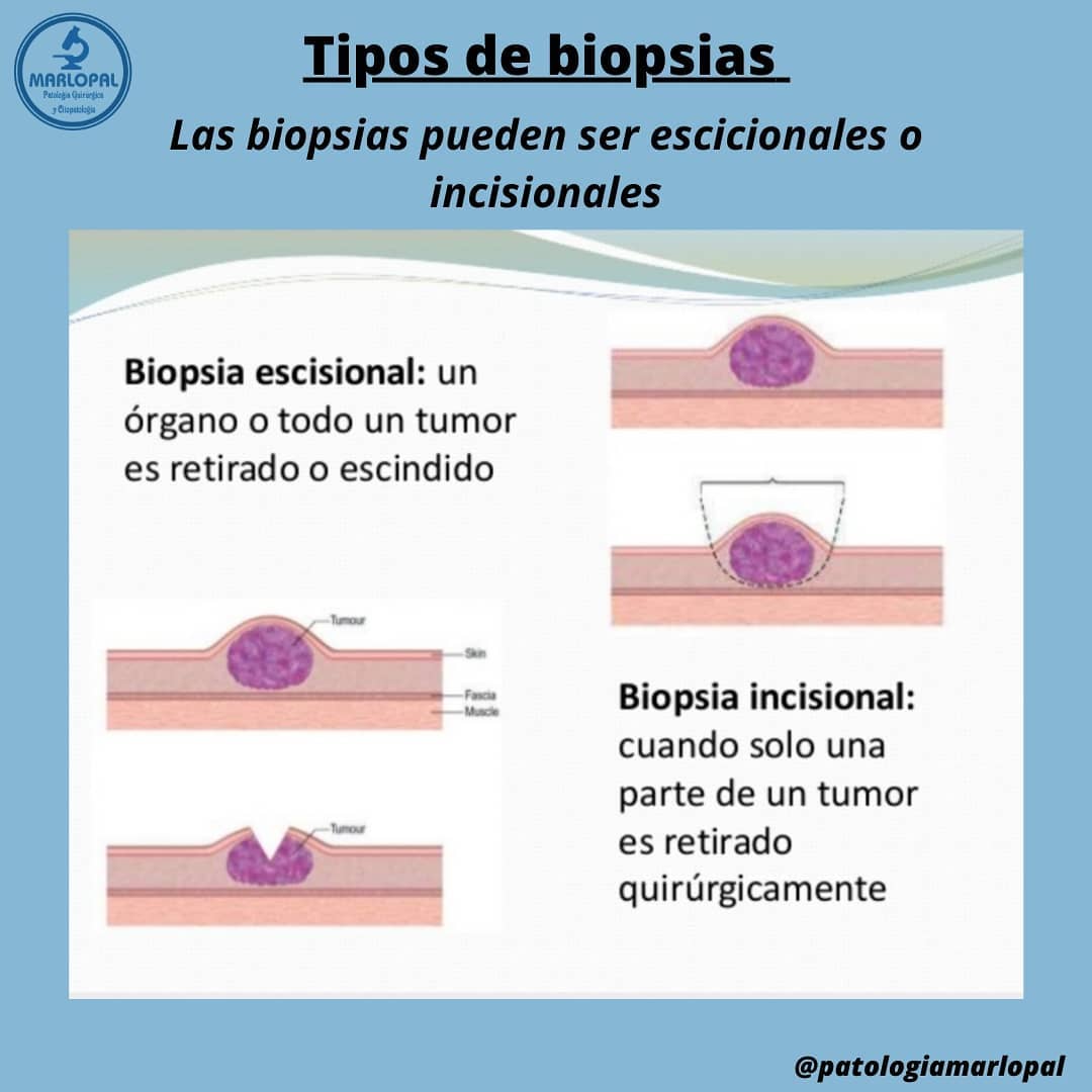☑️ Las escisión o biopsia escisional... - patologiamarlopal | Facebook