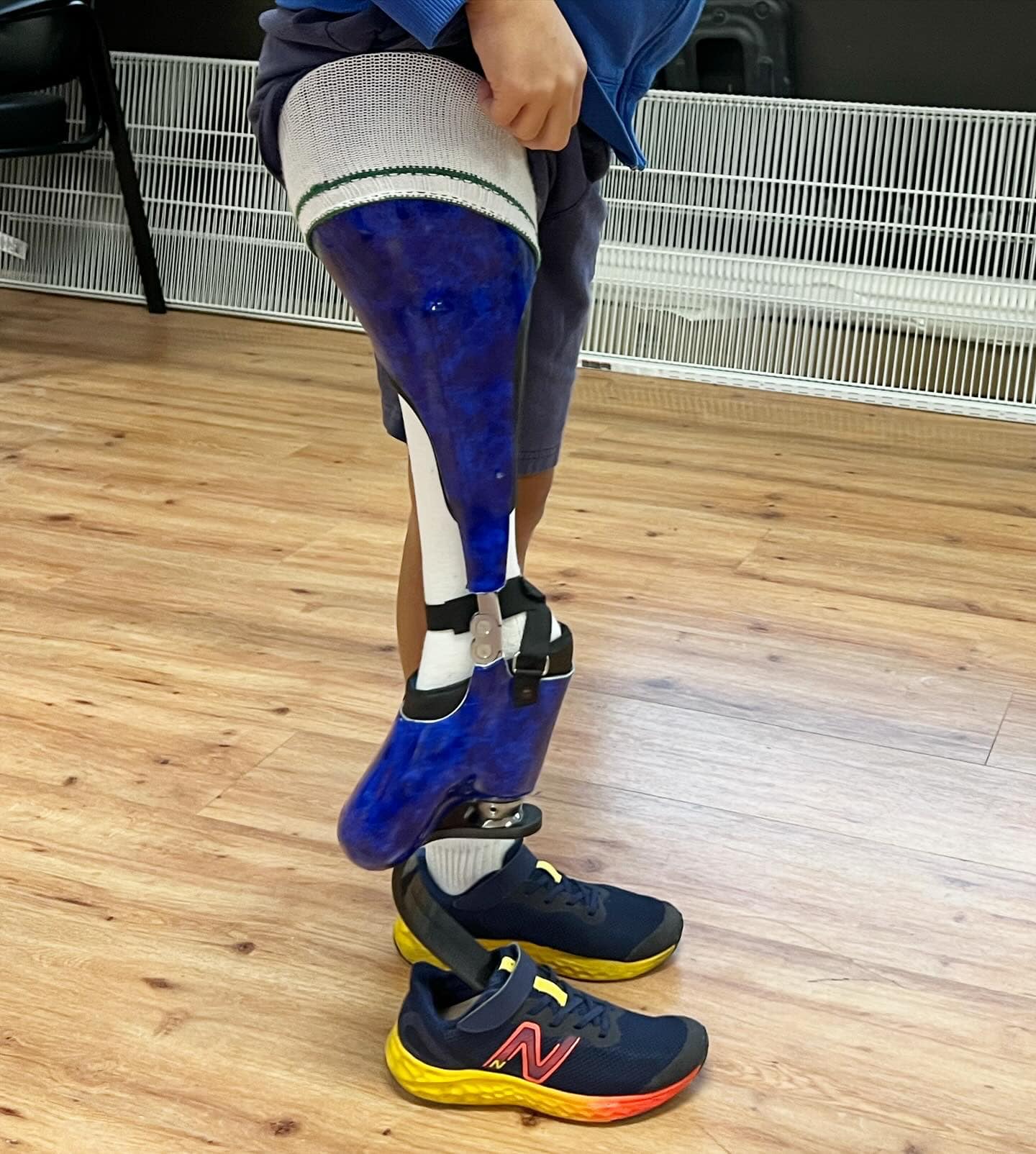 Anna, a PFFD patient, stopped by... - Rotter Prosthetics