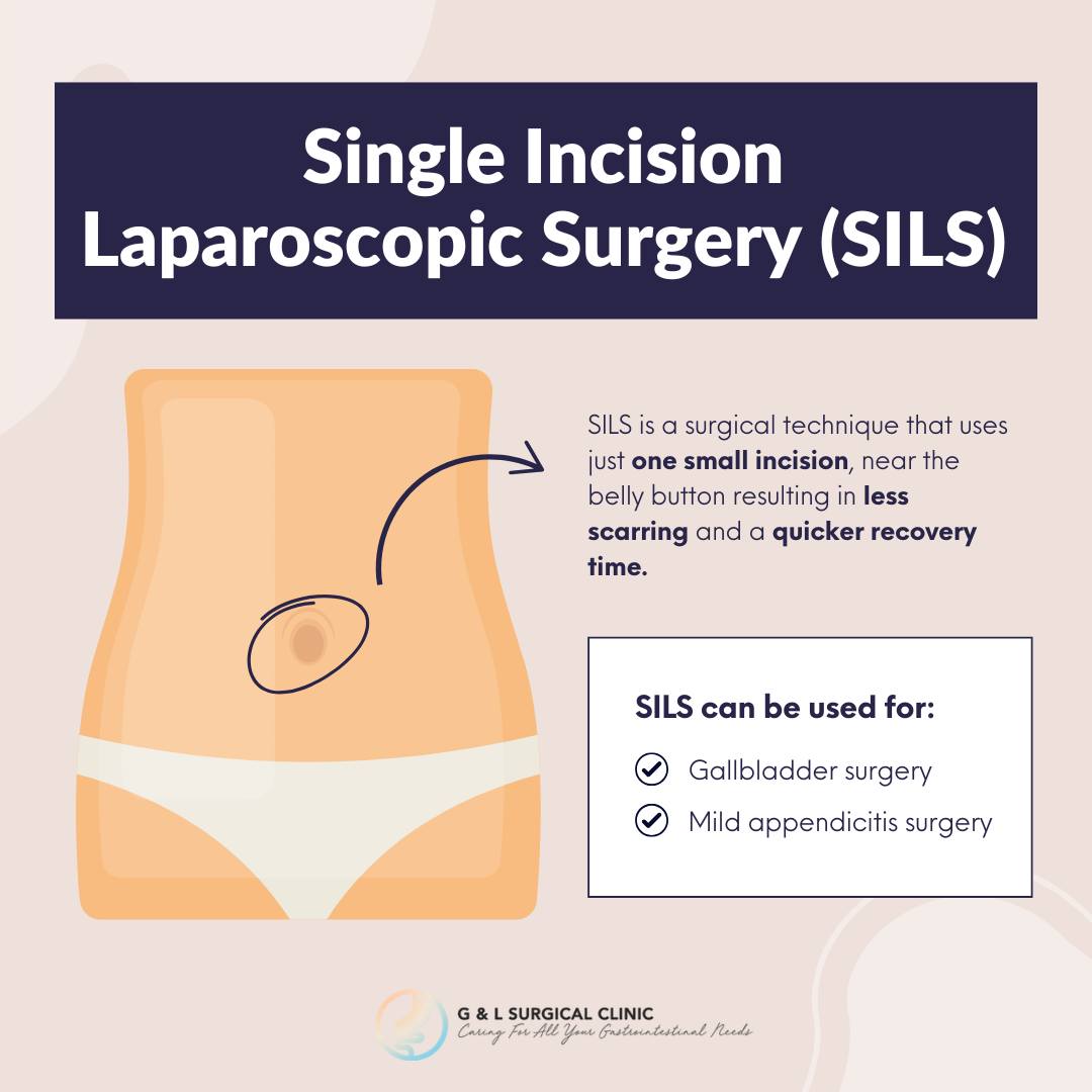 G & - Single Incision Laparoscopic Surgery (SILS) is a minimally ...