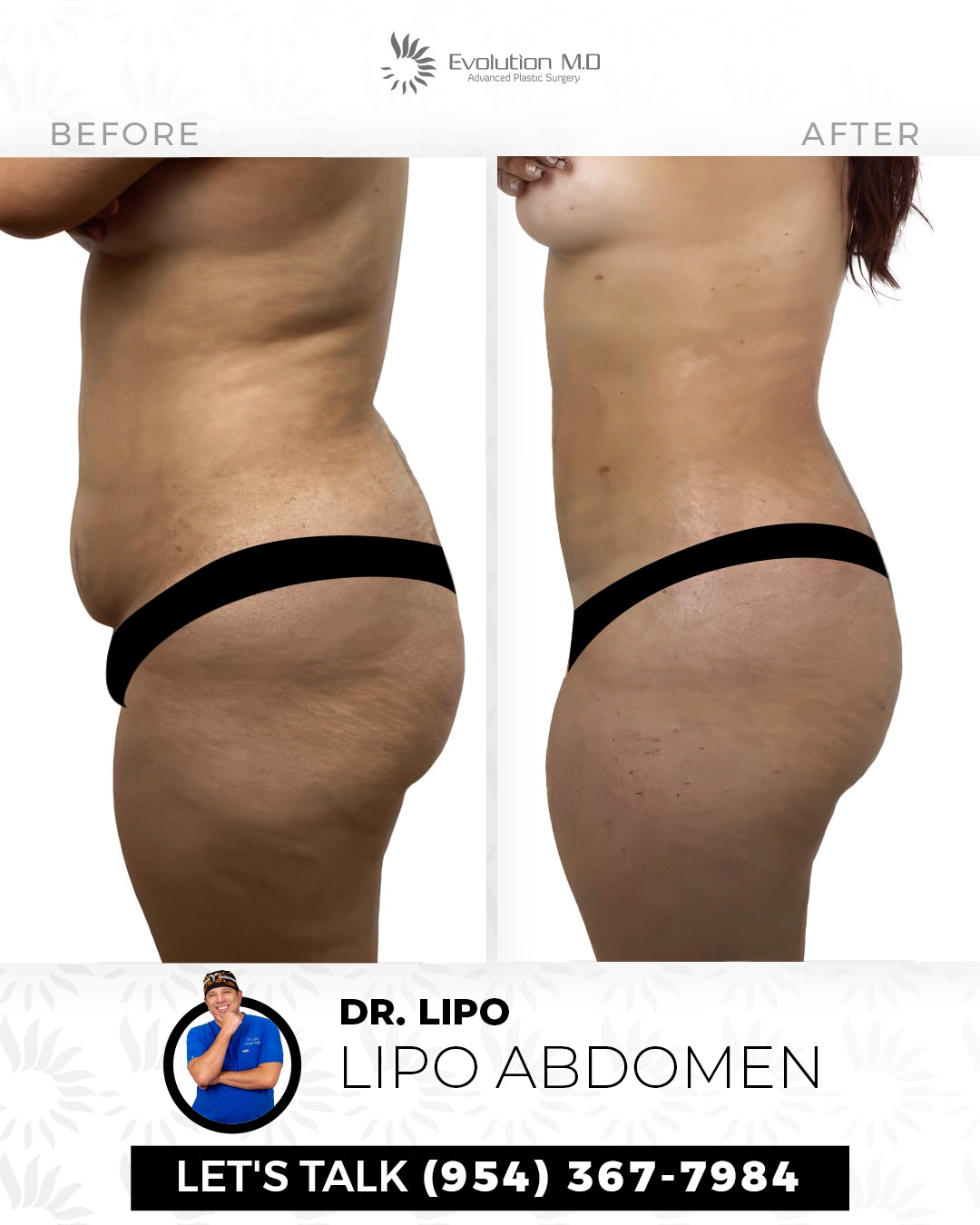 lipo c injection before and after stomach Dr.Lipo of Abdomen. #evolutionMD #Dr.Lipo arginine complex Not all glutathione is mg:10mg/10mg X 10pk