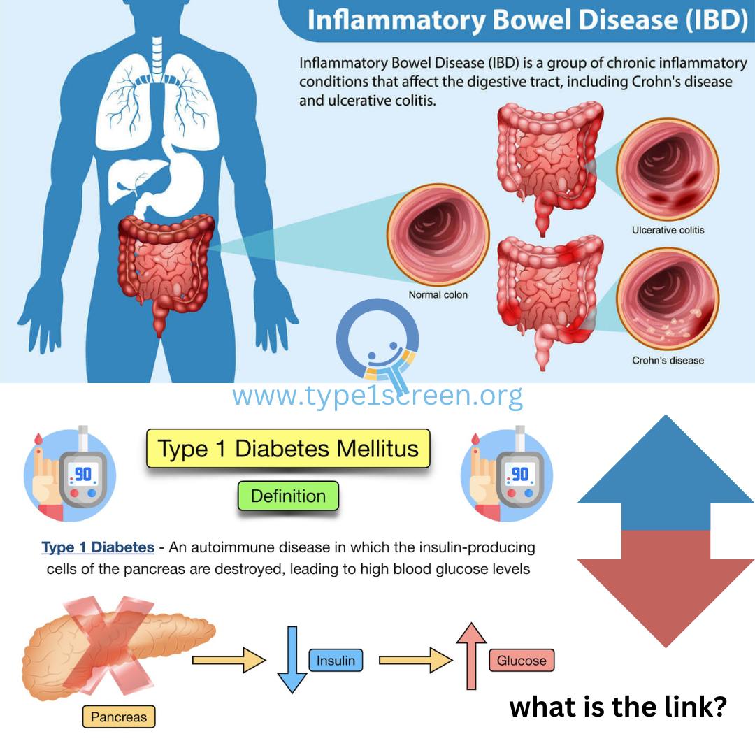 Patients with stable inflammatory bowel disease (IBD) and comorbid obesity and/or diabetes who started GLP-1 receptor agonists (semaglutide or tirzepatide) alongside ongoing treatment did not have a lower risk for the relapse