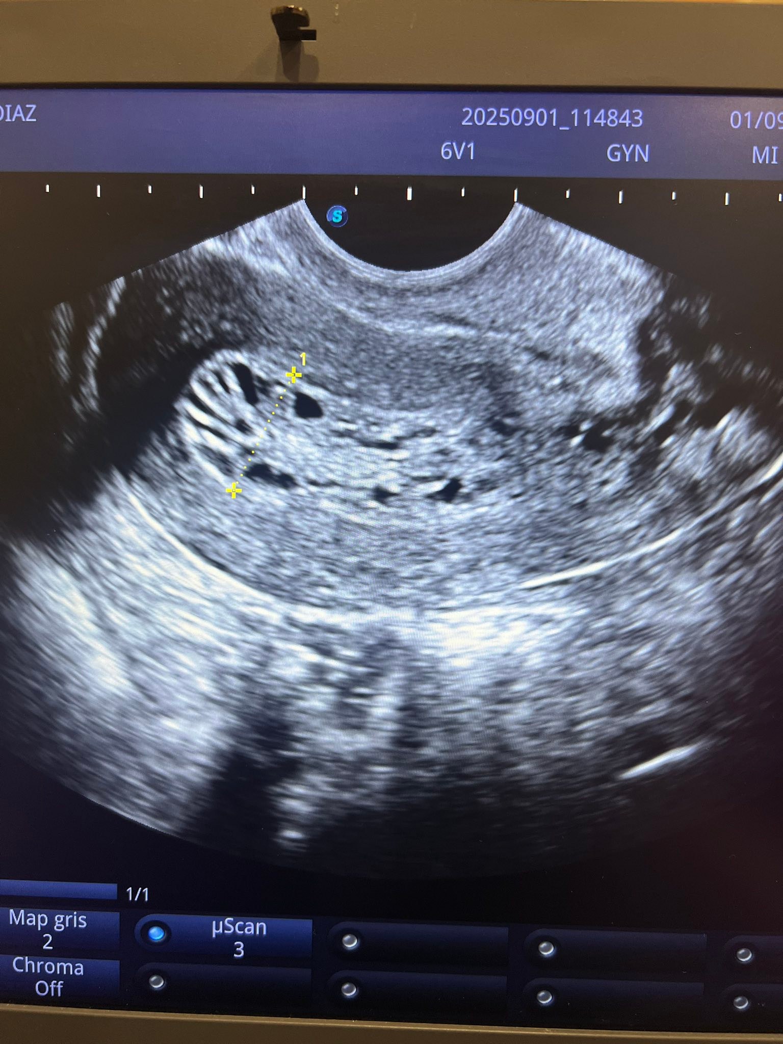 Dra. - La importancia del ultrasonido endovaginal Vean estas imágenes ...