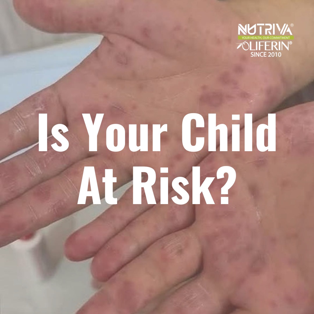 Oliferin - 🚨 HFMD Cases Surge by 266% in Malaysia! 🚨... | Facebook