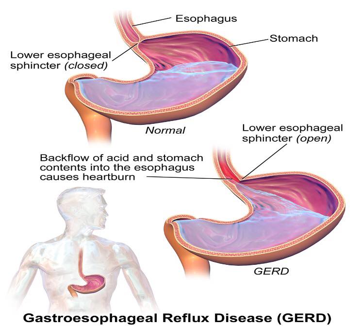 TwasMedical - Gastroesophageal Reflux Disease Definition:...