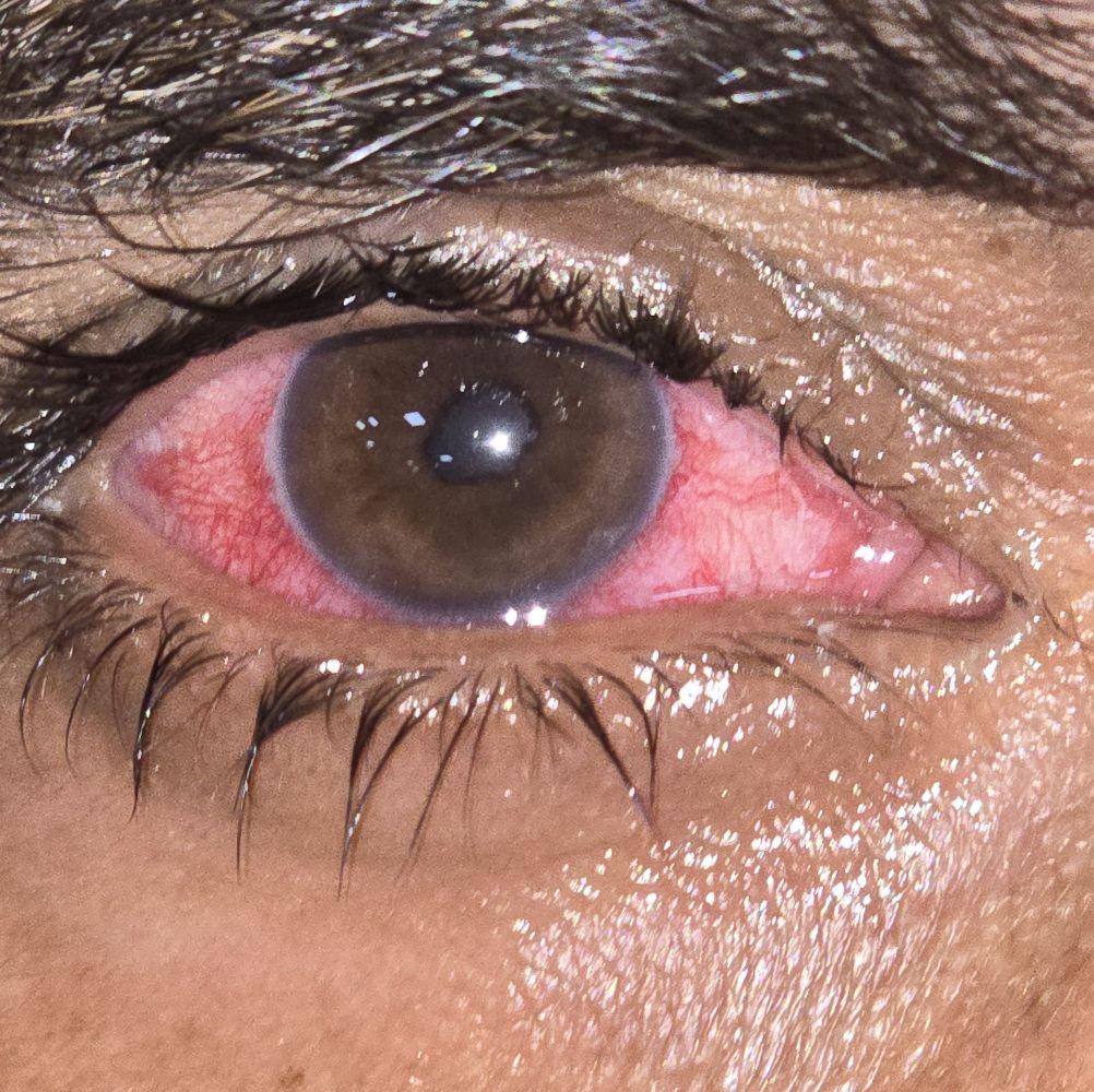 Macular hole oct indices ???? | Eyecare
