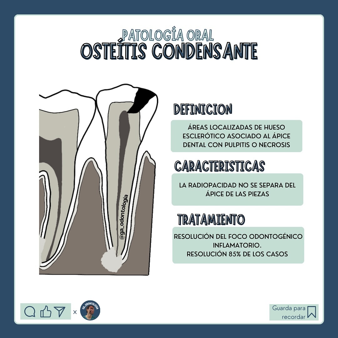 Osteítis condensante - Portal Odontólogos | Facebook