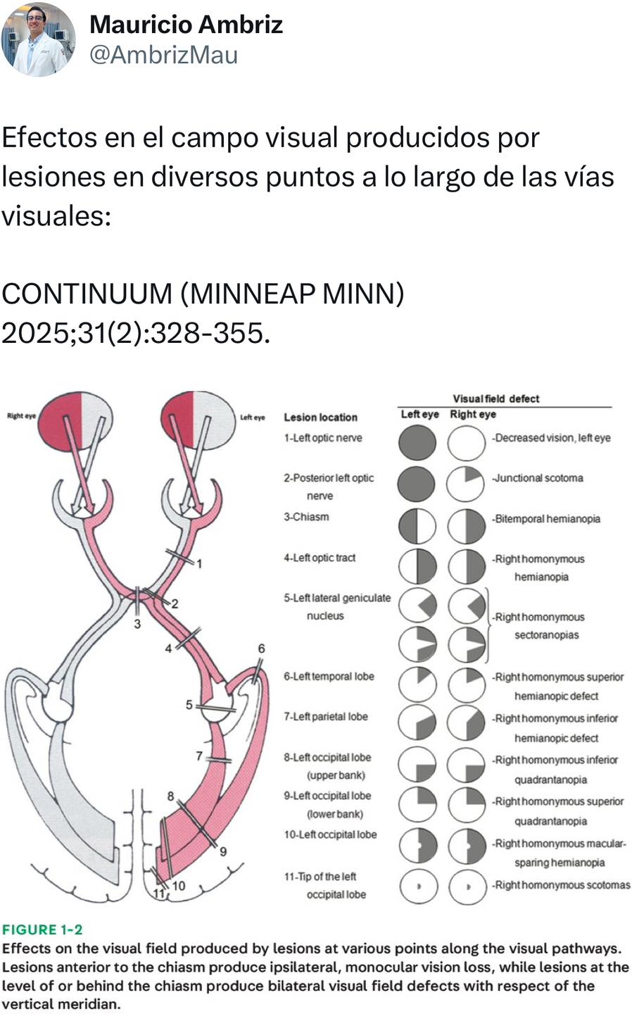 Dr. - www.x.com/AmbrizMau REFERENCIA: Newman N, Biousse V. Approach to ...