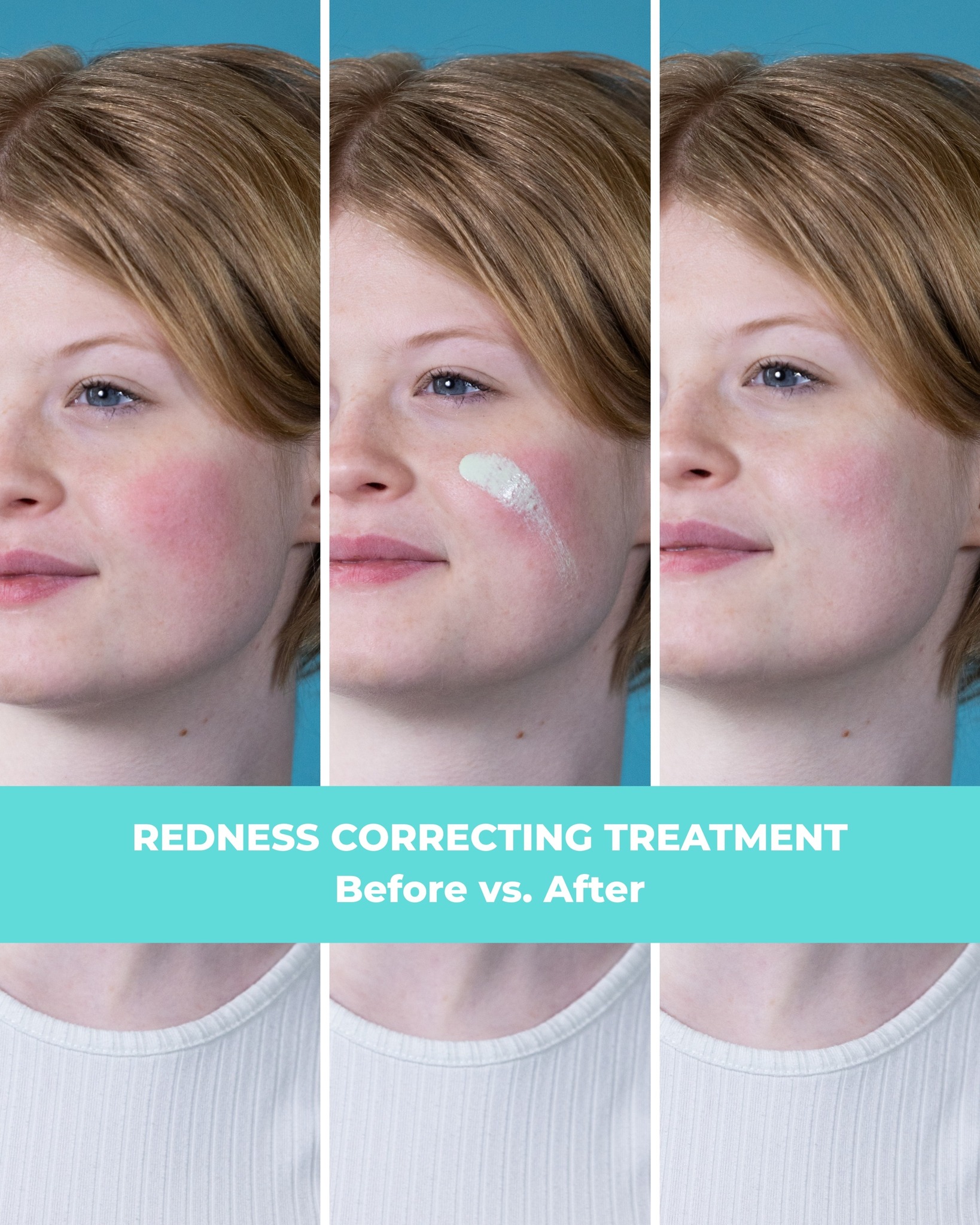 Proactiv - 💚 See the difference — our Redness Correcting Treatment is ...