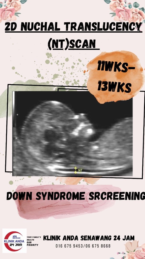Klinik - 💕🌟 NUCHAL TRANSLUCENCY (NT) SCAN 💕🌟 Scan 2D hitam putih ...