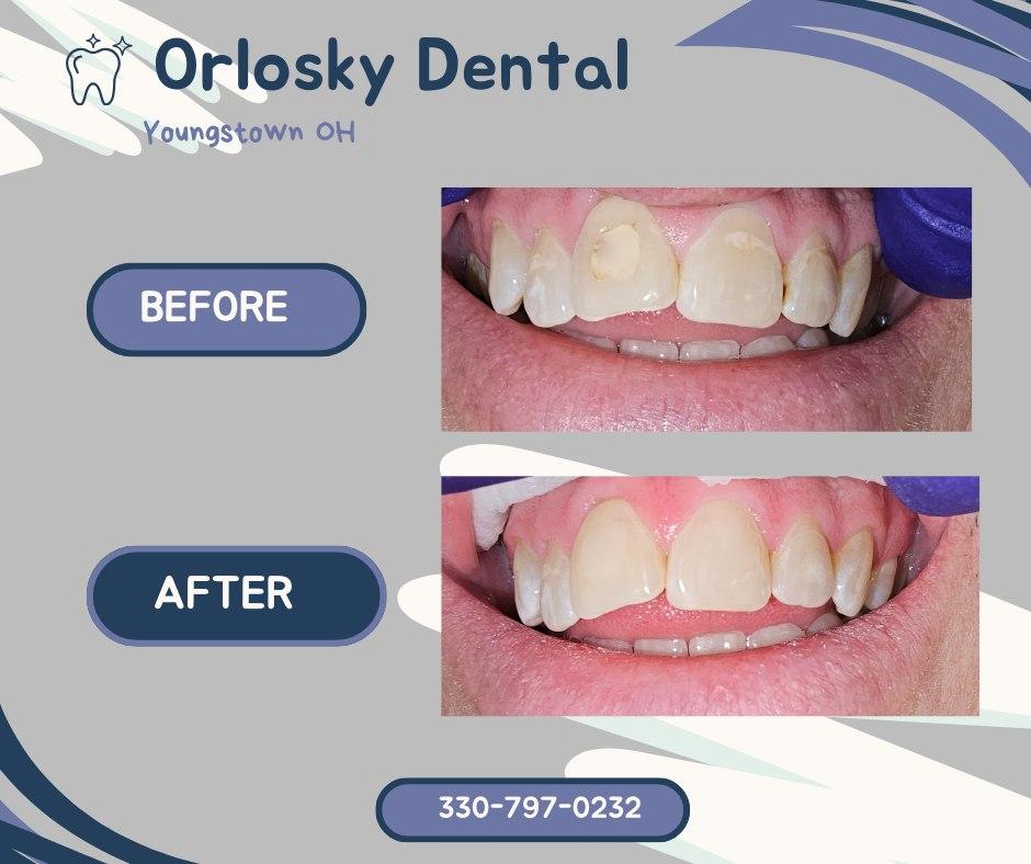Before & After ✨ Decalcification after orthodontic treatment can cause undesirable blemishes on your teeth
