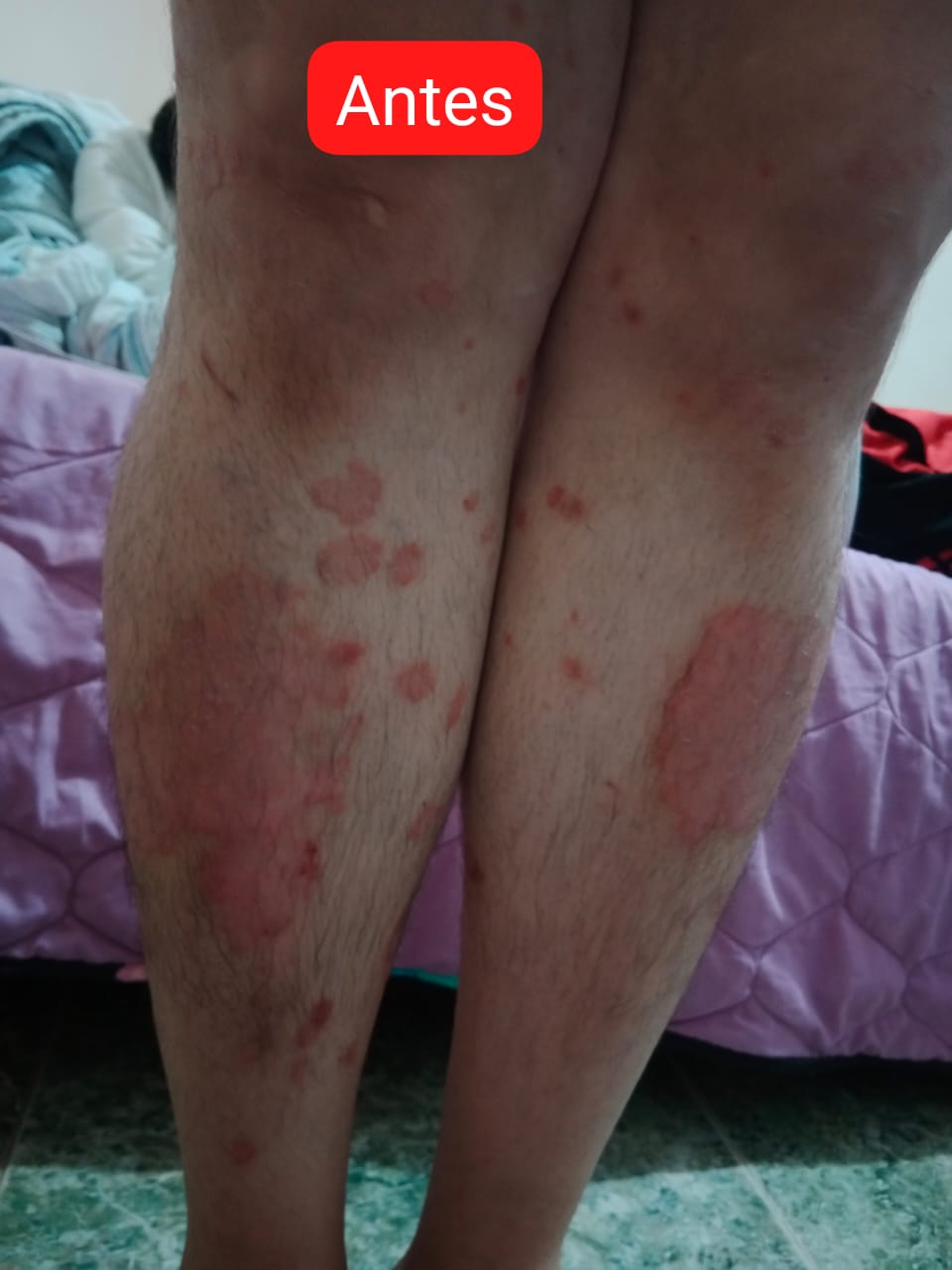 Psoriasis Peru Dermabon | Lima