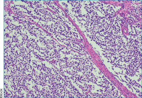 Oncology - Retroperitoneal lymph node dissection (RPLND) results in ...