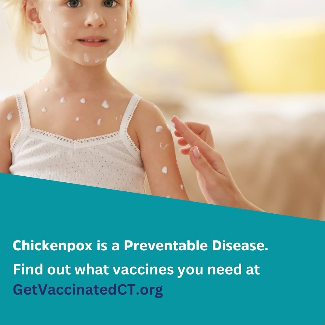 Fairfield - The Varicella (chickenpox) vaccine prevents painful rashes ...