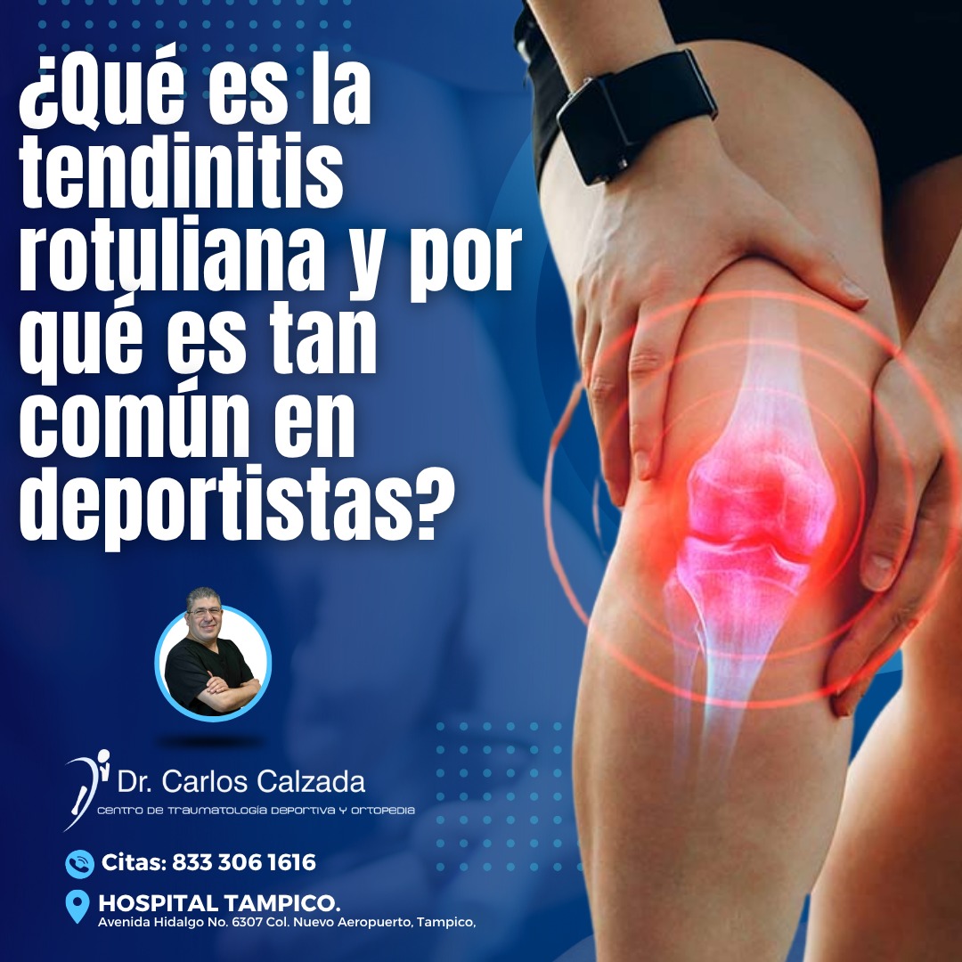 Centro - 🦵 ¿Qué es la tendinitis rotuliana y por qué es tan común en ...