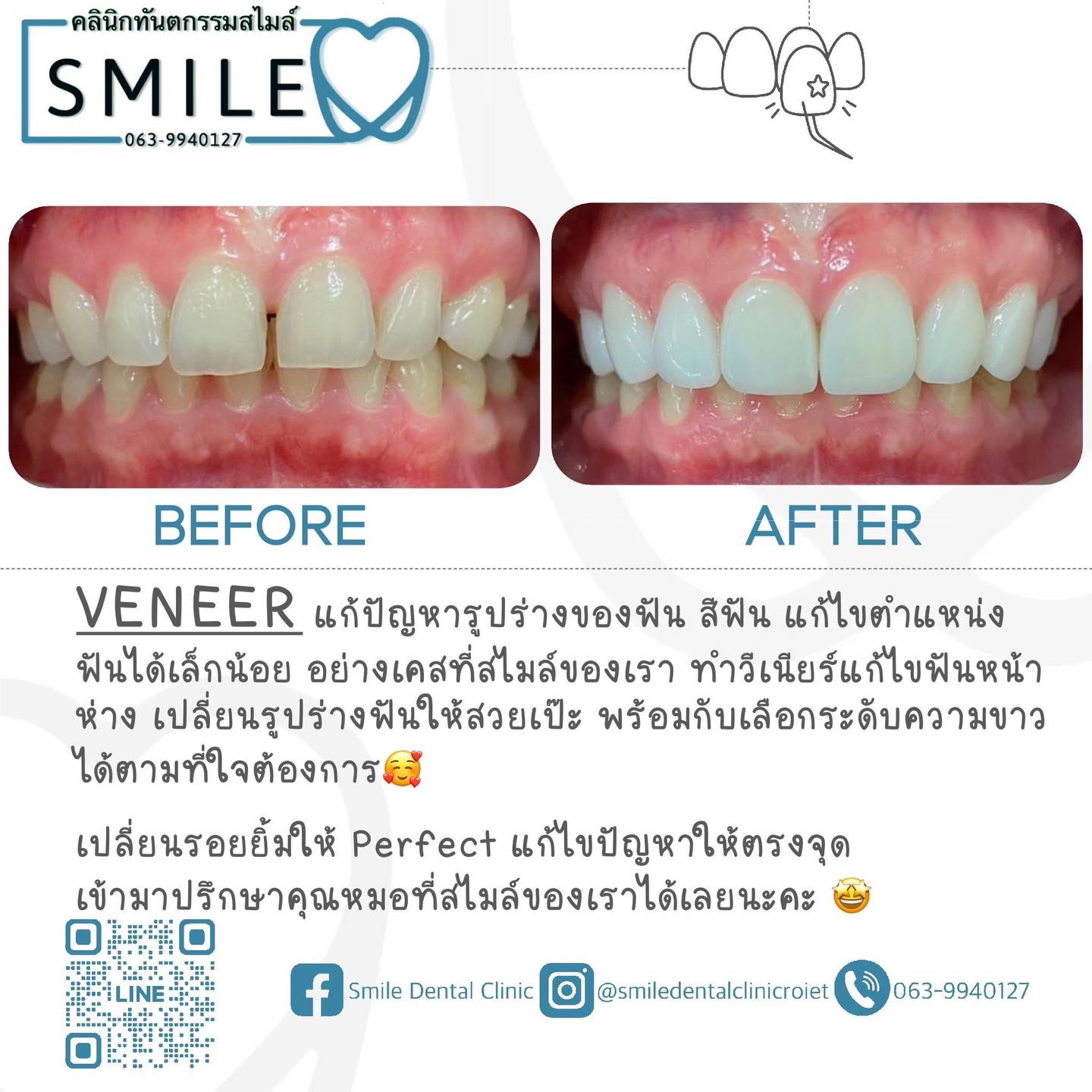 #VENEER แก้ปัญหารูปร่างของฟัน สีฟัน แก้ไขตำแหน่ง ฟันได้เล็กน้อย อย่างเค ...