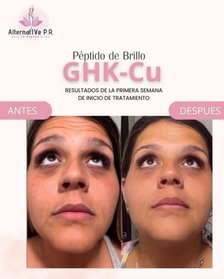 ghk cu resultados Solo 1 semana. 🤍✨ Alternative PR Health Center CORP. Cada piel responde de forma diferente, pero cuando se combina un protocolo adecuado con constancia, los cambios comienzan a notarse. GHK-Cu es un 10 mL BAC Water