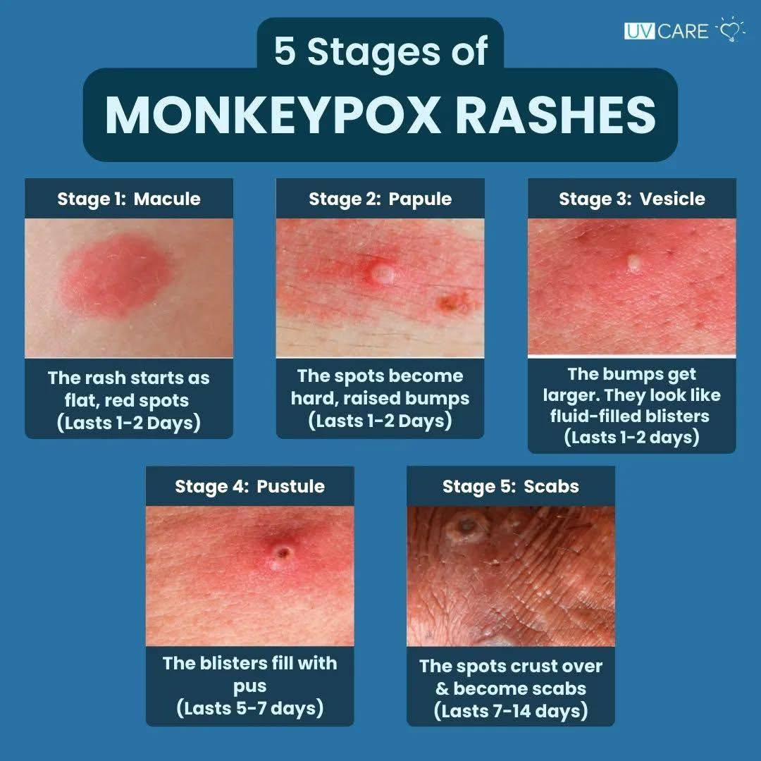 STARR - 5 Stages of monkeypox rashes | Facebook