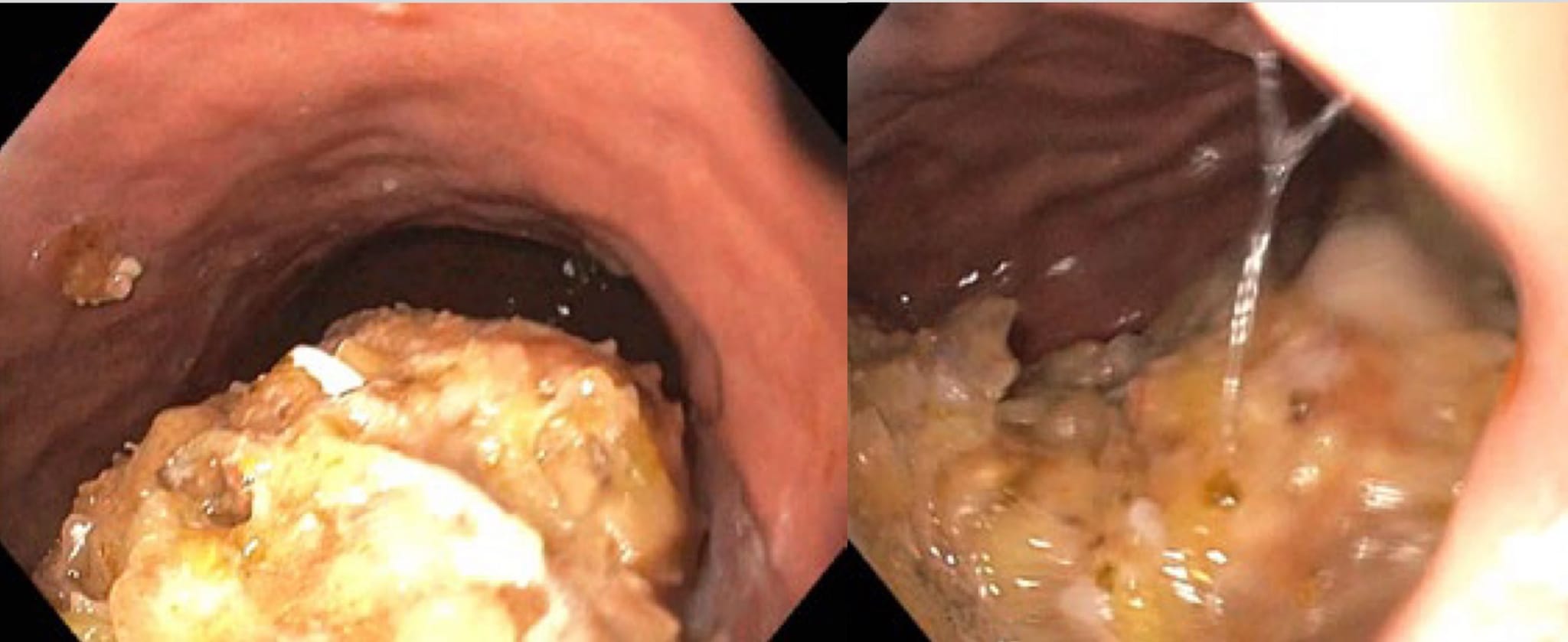 Semaglutide side effect: Gastroparesis in 69-year-old female