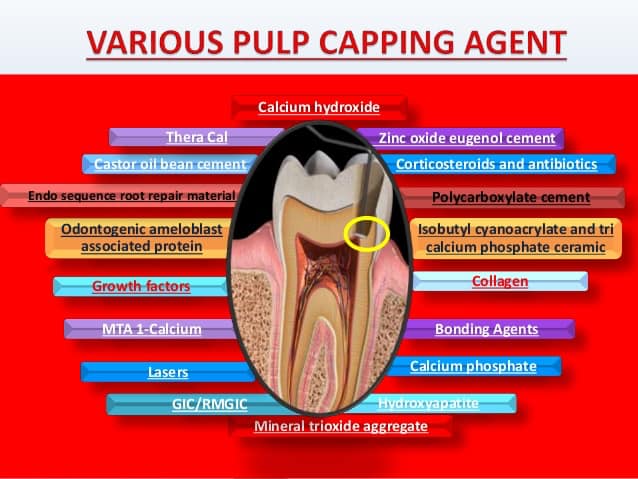 Pulp capping... - သွားဆေးခန်း Laser Light Dental Clinic