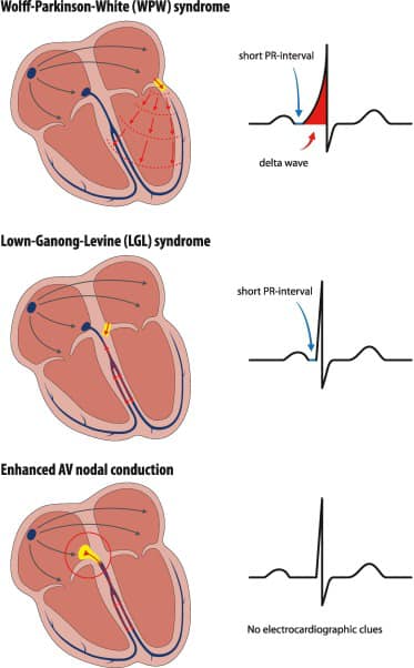 Cardiophilia - Lown–Ganong–Levine (LGL) Syndrome. A rare... | Facebook