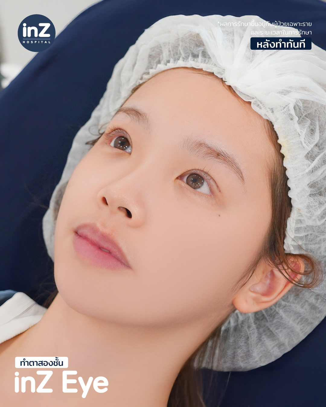 นี่คือผลลัพธ... - Inz clinic หมอหลิน ทำตาสองชั้น โดยจักษุแพทย์ | Facebook