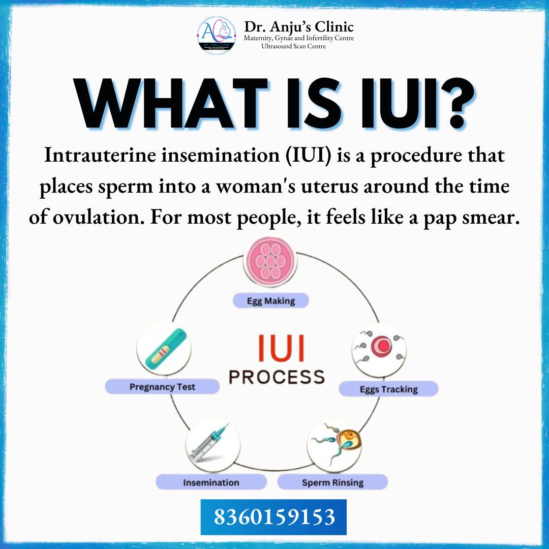 Dranjuclinic - What is IUI? IUI (Intrauterine Insemination) is a ...