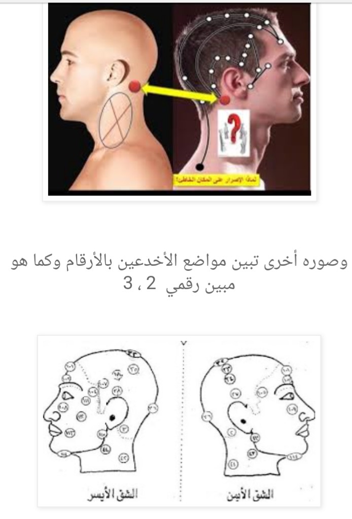 العلاج بالقرآن الكريم حجامة الأخدعين لا انصح الناس بالذهاب لبعض الحجامين الذين لا ي ستطيعون تحديد نقاط الحجامة بالش كل الصحيح وخاص ة في مسألة حجامة الأخدعين لأنها منطقة خطيرة إن لم ت حد د بالش كل
