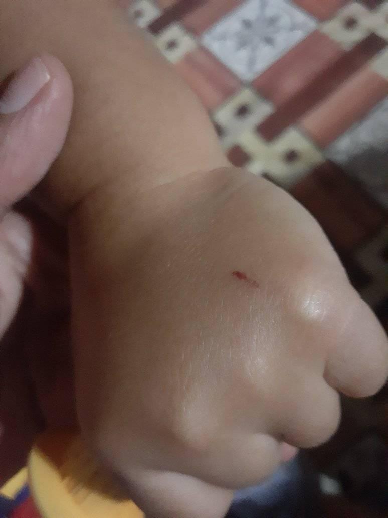 ITO PO ANG SINUSUNOD NG DOH AT LAHAT NG ANIMAL BITE CENTER NA PROTOCOL ...