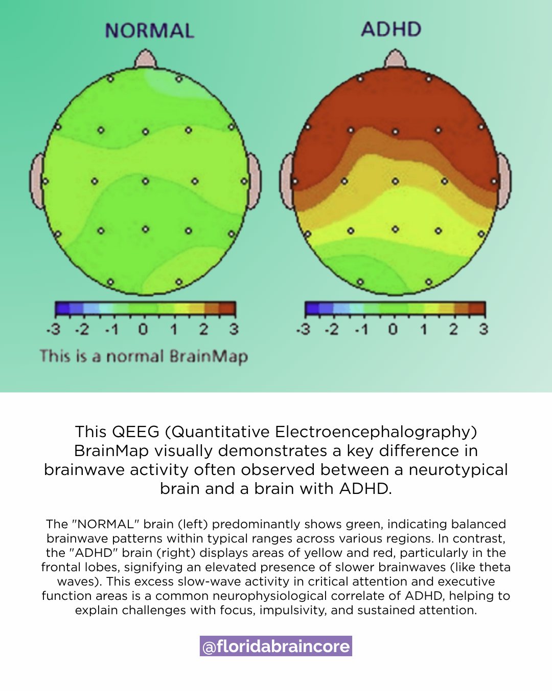 Florida - Ever wonder how ADHD shows up in the brain? QEEG brain ...