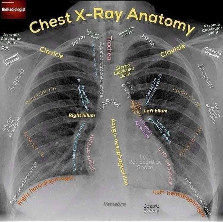 Medical - Chest XRay made easy | Facebook