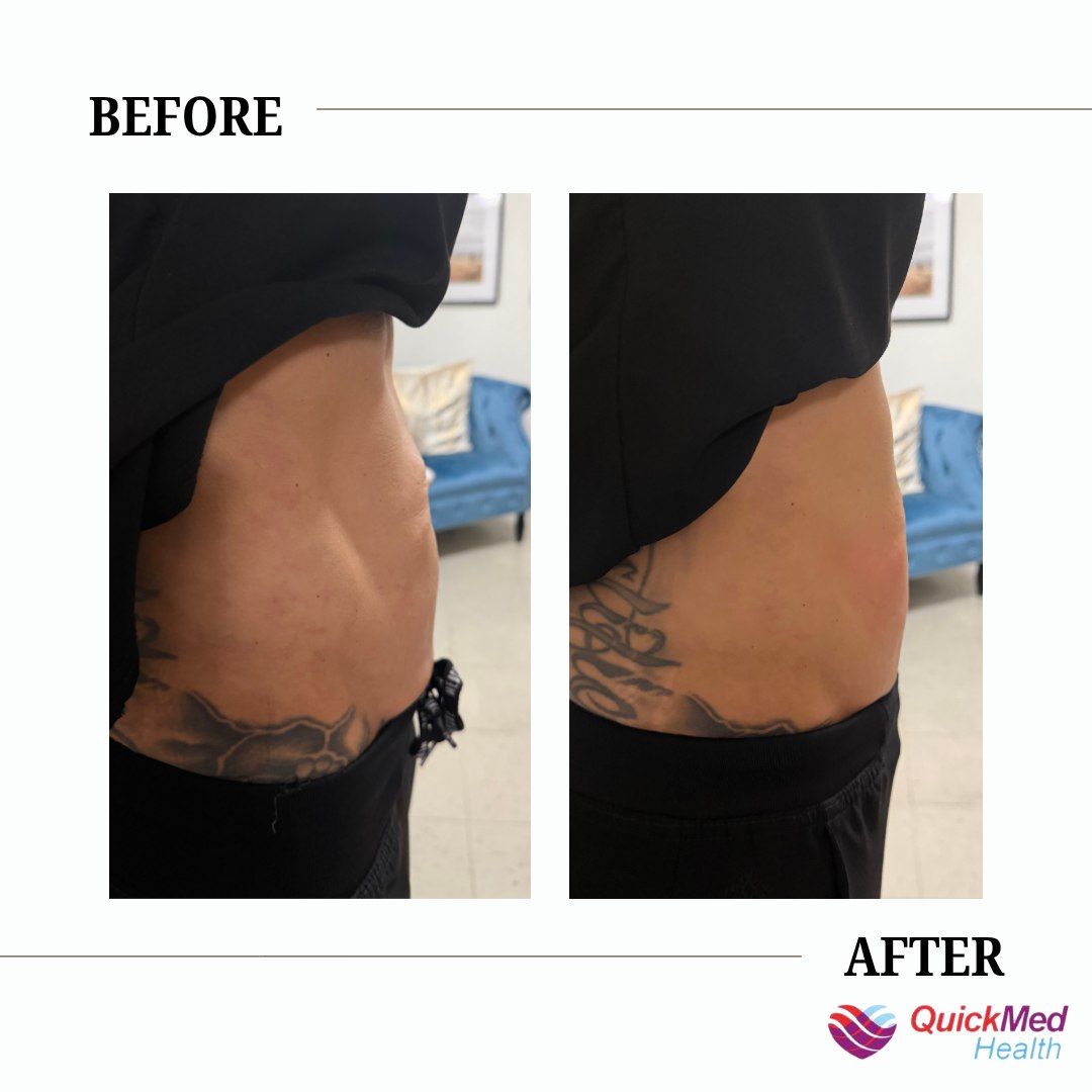 klow peptide before and after New at QuickMed Health! 🎉 Ever heard of + GLOW peptides wondered what the hype is about? Let us break it down for you! 💧 KLOW Supports healthy skin, hair VetriScience Liver Support Antioxidant alcoholism Size:10mg Nasal Spray