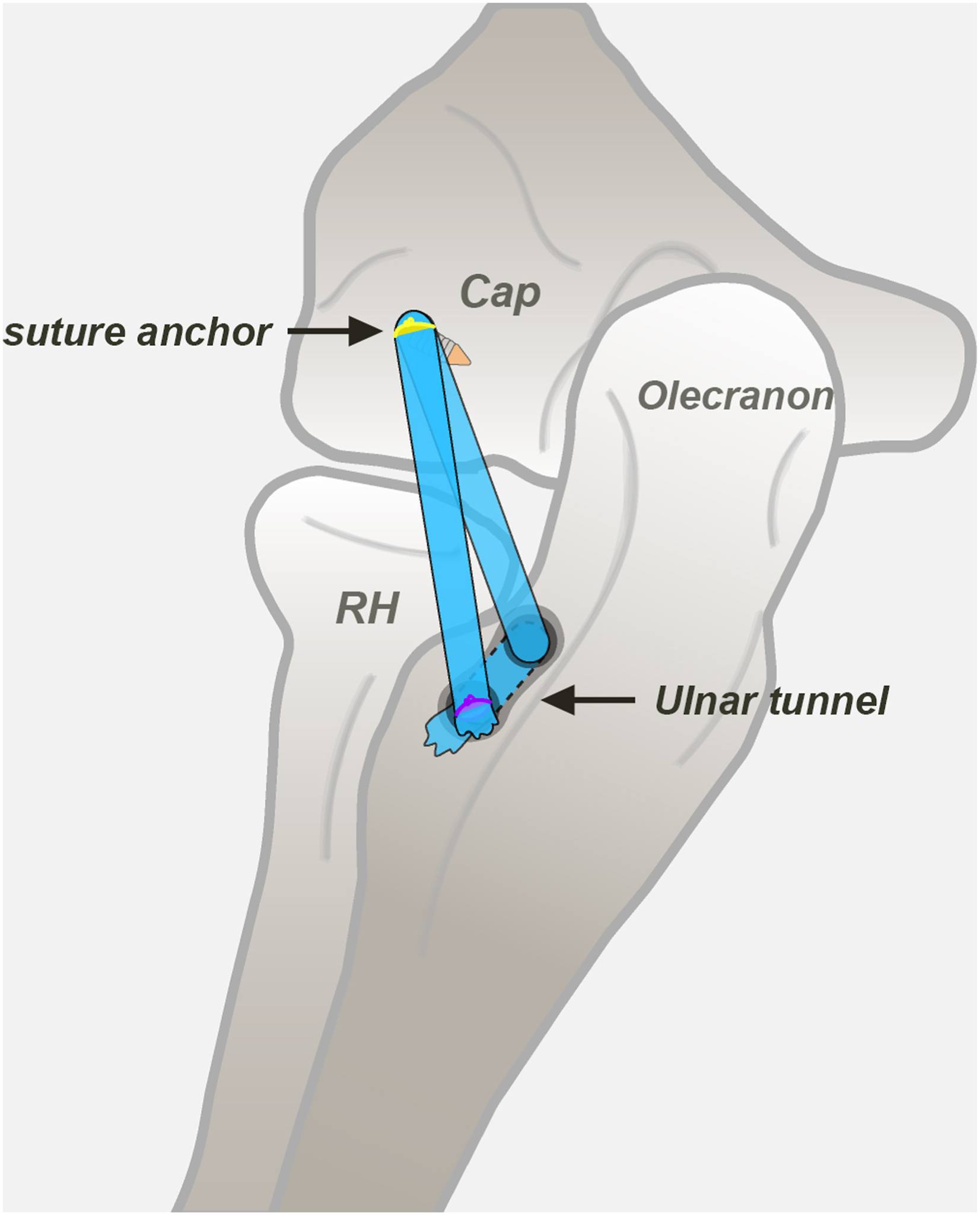 Arthroscopy - Arthroscopic-Assisted Lateral Ulnar Collateral Ligament ...