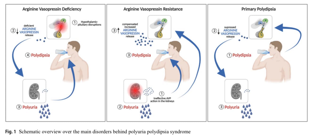 Polyuria polydipsia... - Philippine Society of Nephrology | Facebook