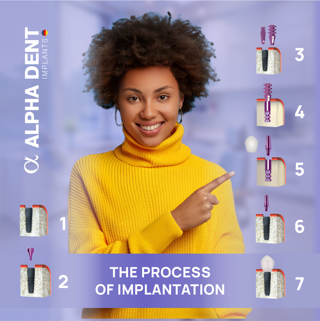 The implantation process of... - Alpha Dent Implants GmbH.