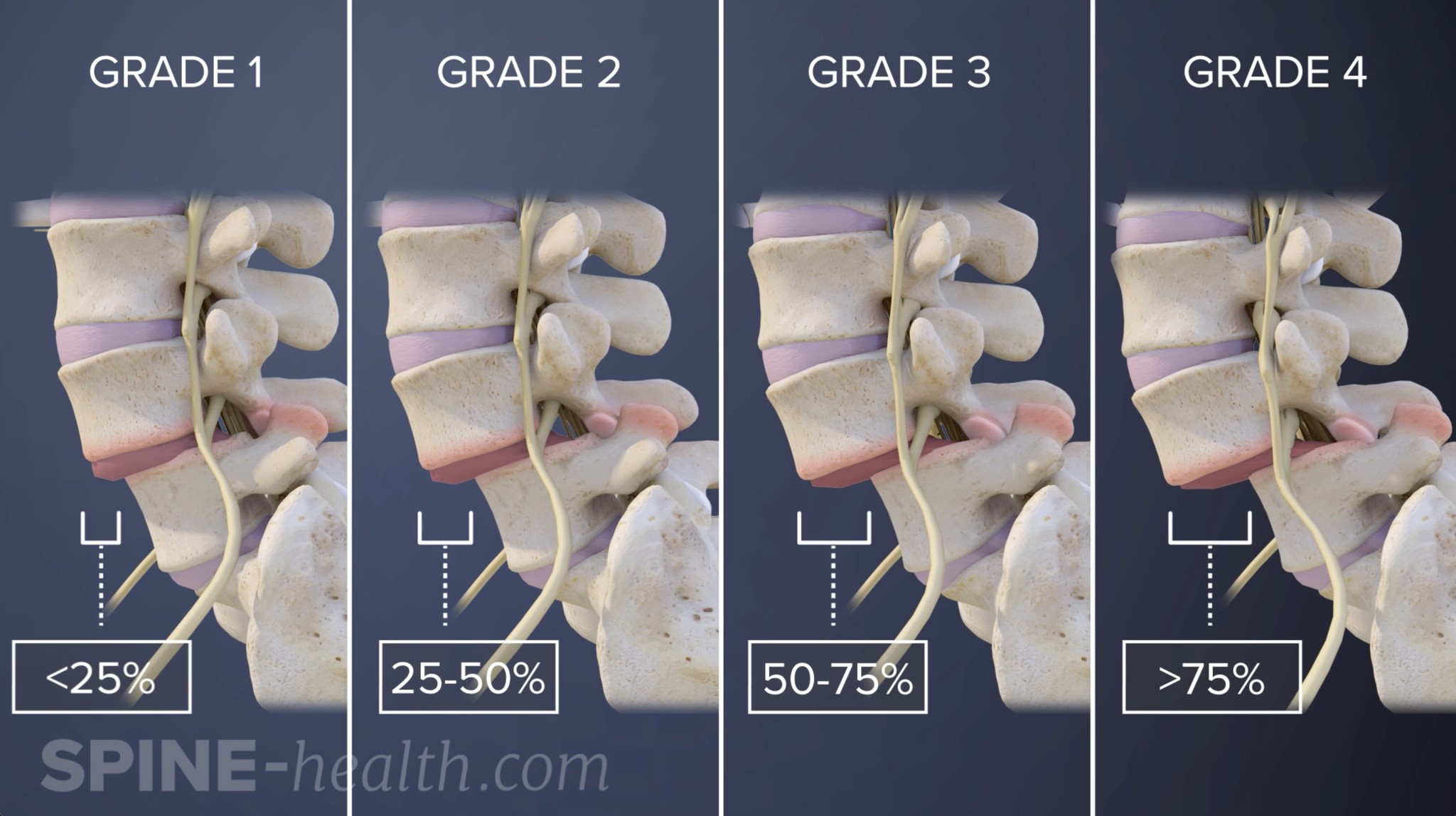 Spine-health - Degenerative spondylolisthesis is graded by how much one ...