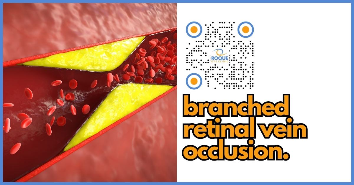 ROQUE - Branch Retinal Vein Occlusion (BRVO) is a common retinal ...