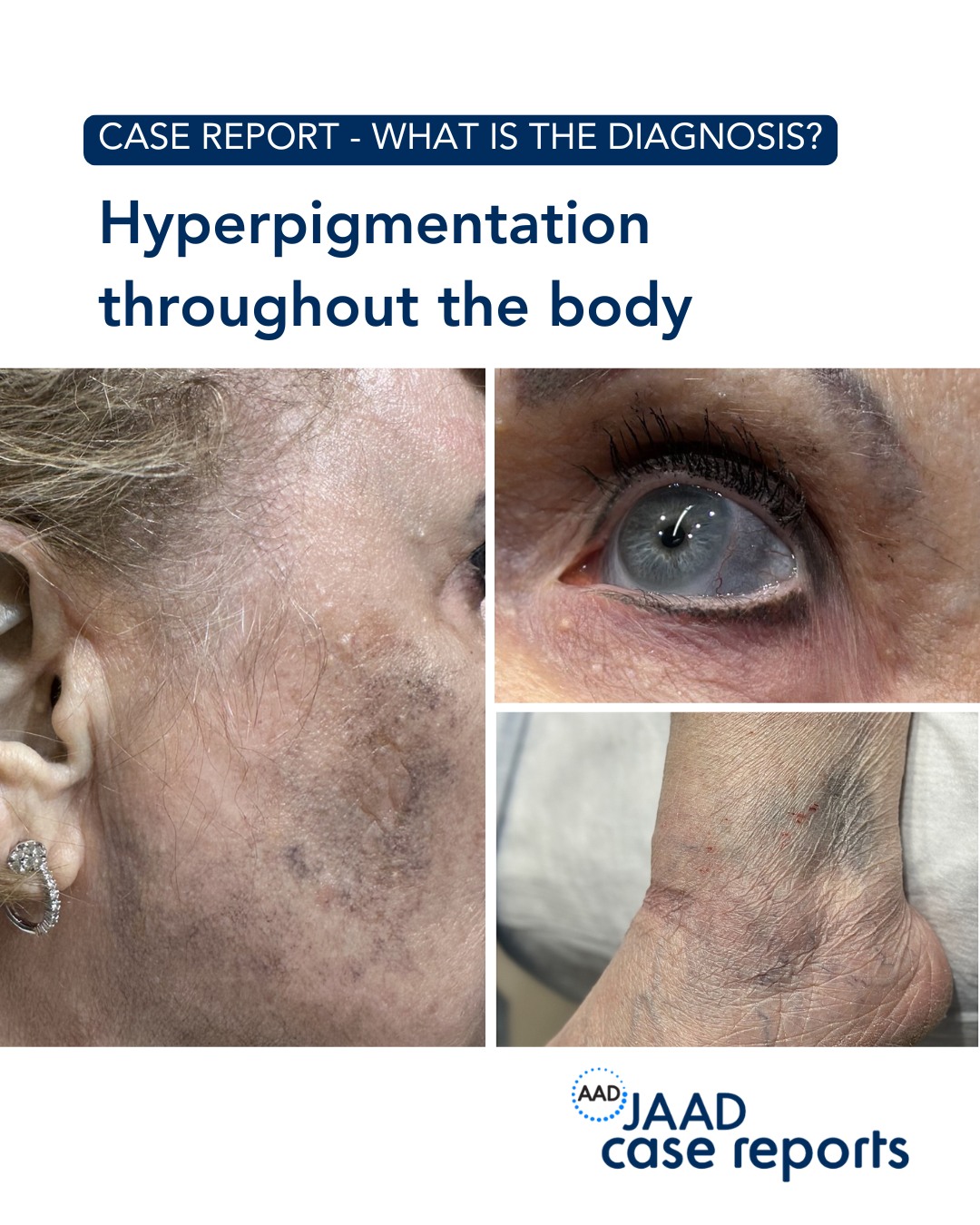 glutathione plaquenil hyperpigmentation A 55-year-old woman presented to the dermatology clinic with a 1-year history of skin darkening on her face. Two years before presentation, she had started applying a skin-lightening cream containing hydroquinone to HEALTHY PLACE DOUBLE TONING