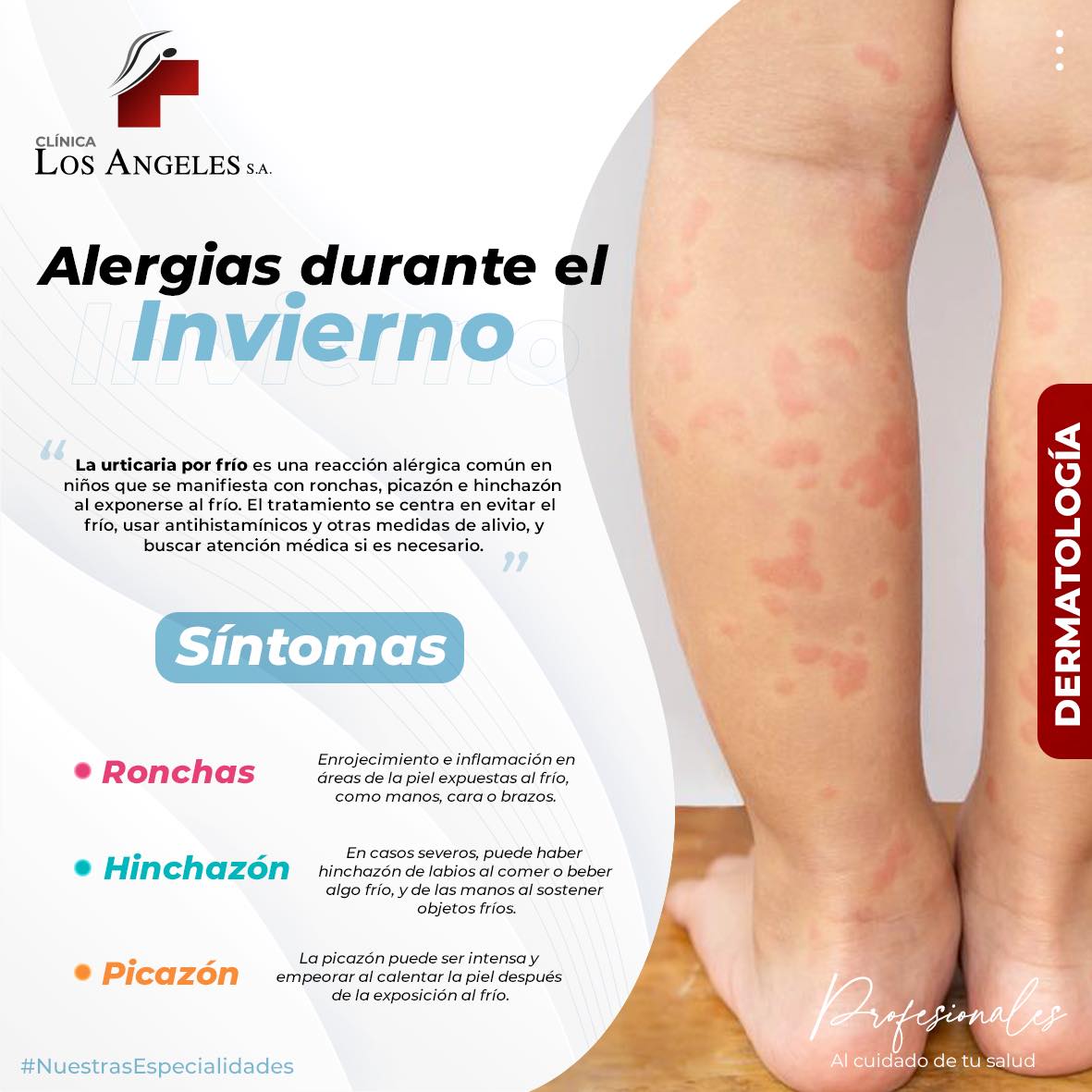 Clínica - ️ Alerta: Urticaria por frío - ¿Tu hijo presenta estos ...