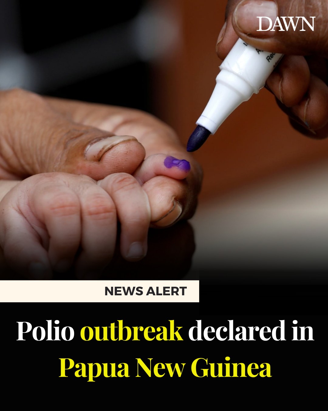 Dawn.com - A polio outbreak has been declared in Papua New... | Facebook