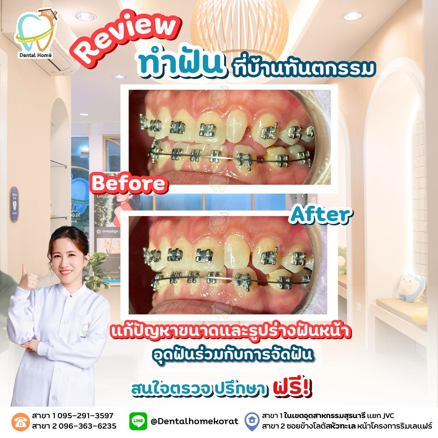 Dental - รีวิว อุดเติมฟันหน้าร่วมกับการจัดฟัน เพื่อแก้ปัญหาขนาดและรูป ...