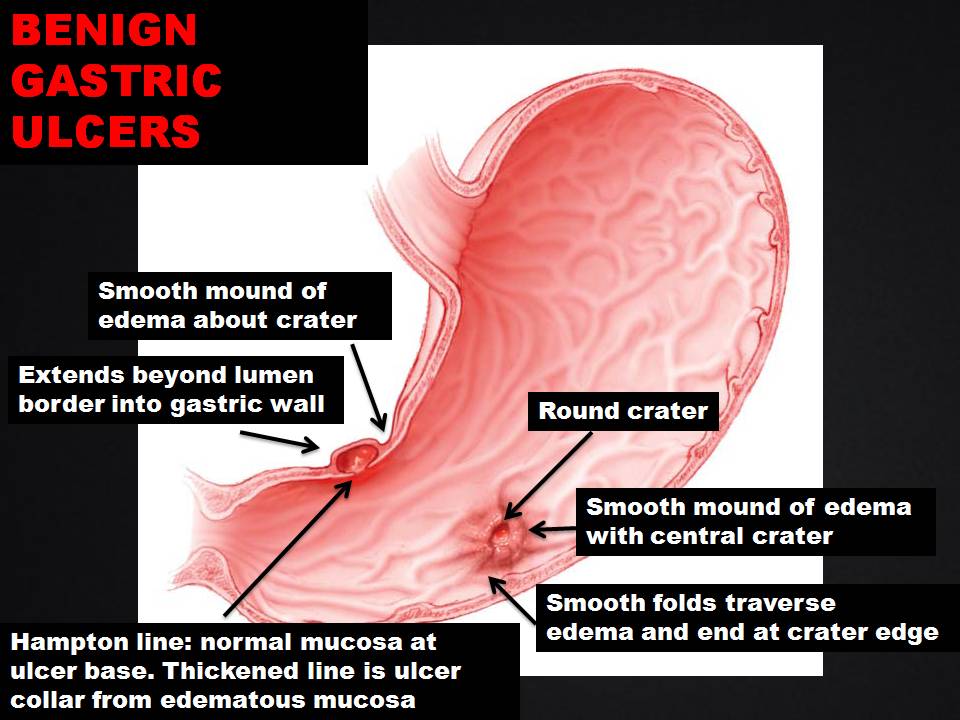 BENIGN vs MALIGNANT GASTRIC ULCERS... - Radiology Classroom | Facebook